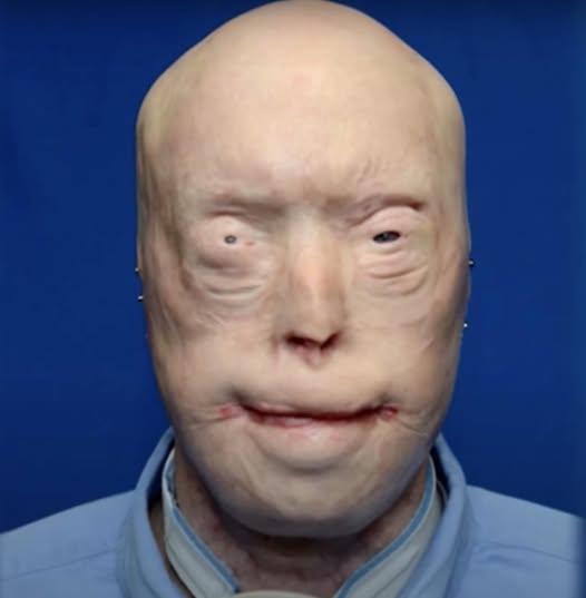 HT10. Firefighter Has Face Transplant After Third-Degree Burns And Survives Against All Odds – See Him Now, 7 Years Later