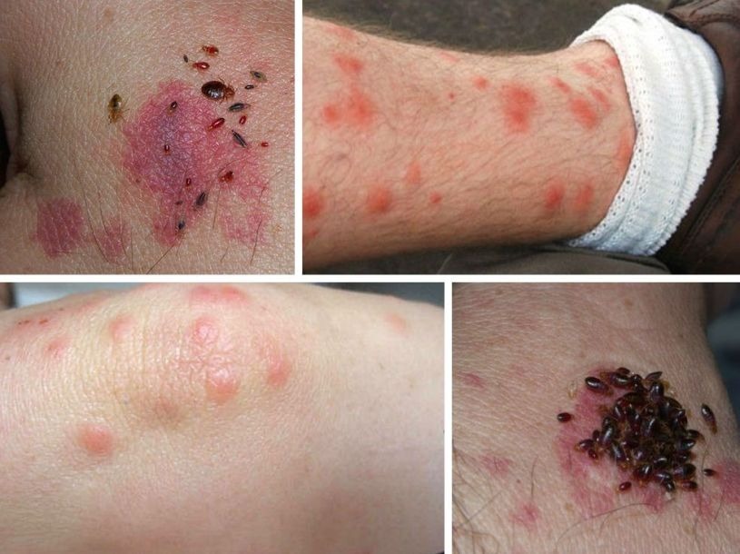 HT15. BE CAREFUL if you get these bruises on your body, it means you have Ca…