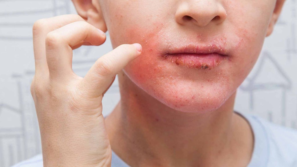 HT10. Her body was itching, thought it was an allergy but they diagnosed ca…