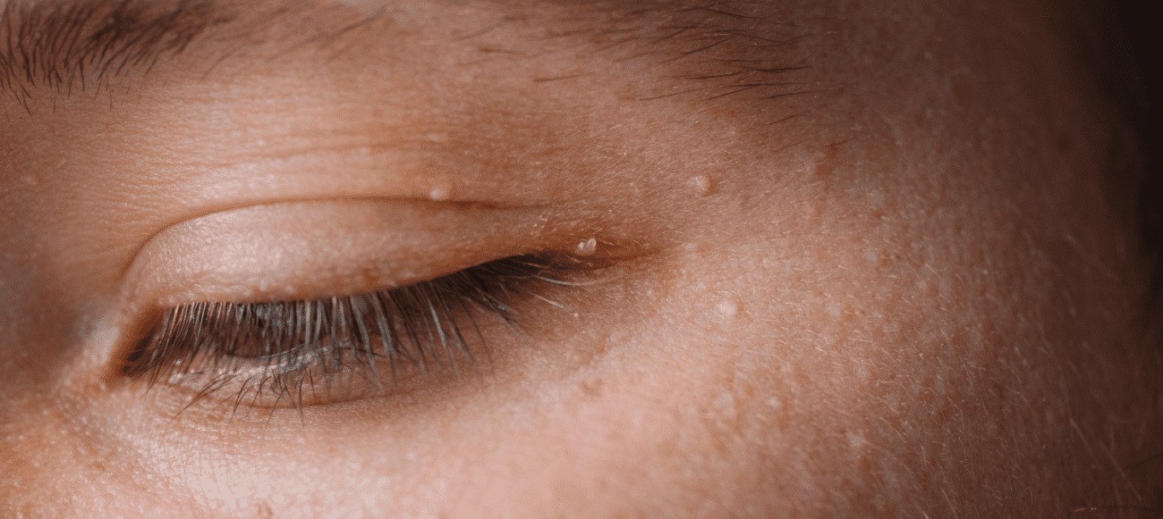 HT7. When White Bumps Appear on Your Skin, What Is Your Body Trying to Tell You?