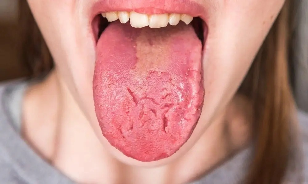 HT16. What Your Tongue Reveals About Your Health: Surprising Clues You Shouldn’t Ignore