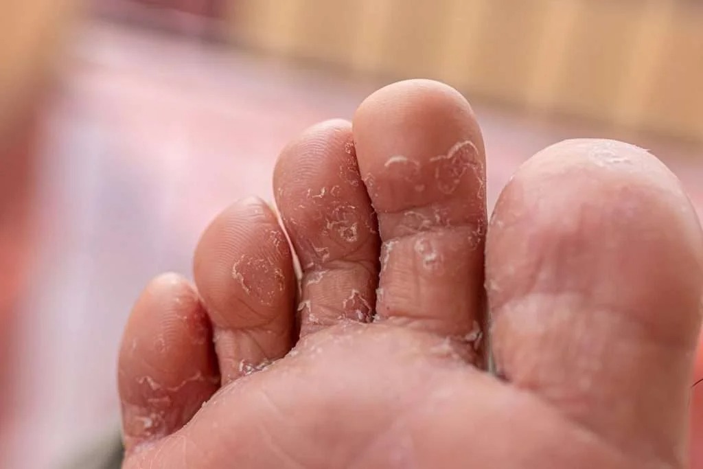 HT10. Looks Like an Infection Between My Toes. Couldn’t See a Doctor, So I…