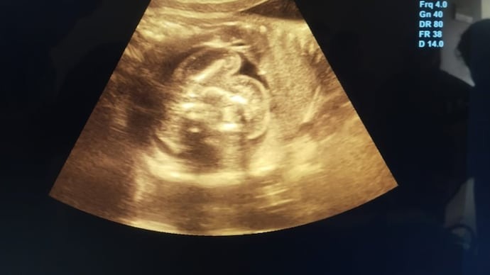 HT1. She cried with happiness, they told her she was pregnant with triplets, but the… See more