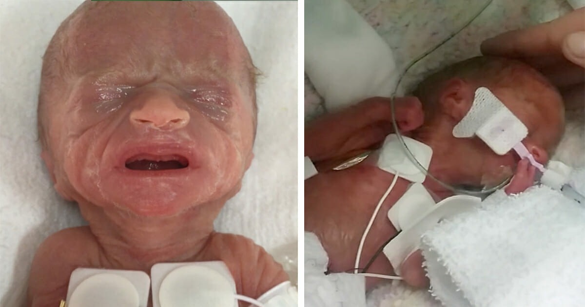 HT1. Tru Beare’s Incredible Journey: From a 1-Pound Premature Birth to a Thriving Toddler