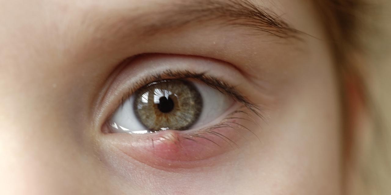 ST1. These Could Be Early Signs of an Eye Infection