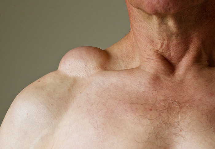 HT10. Doctors Couldn’t Believe What Was Inside This Swelling… See for Yourself