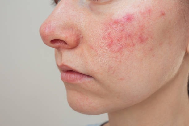 HT16. Her body was itching, I thought it was an allergy, they diagnosed ca… see more
