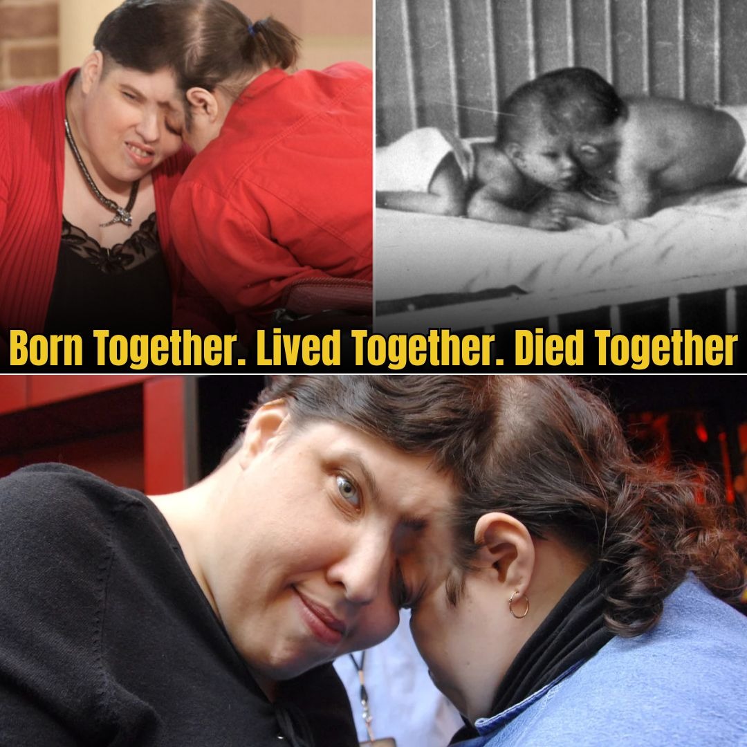 HT14. World’s Oldest Conjoined Twins Passed Away at 62 — After a Lifetime of Defying the Impossible
