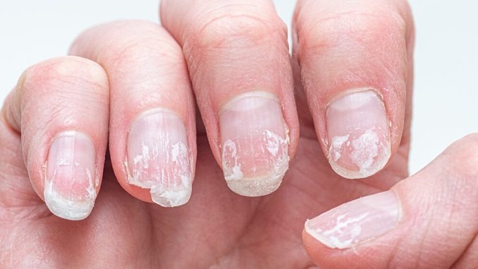 HT10. Rippled fingernails reveal secrets of possible disease