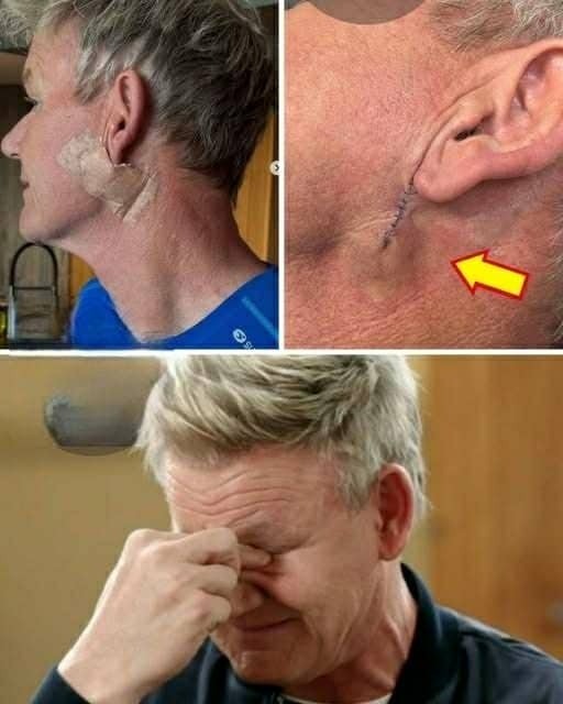 HT10. Fans in Shock as Gordon Ramsay Reveals Cancer Battle — TV Chef Shows Surgery Scars After Devastating Diagnosis