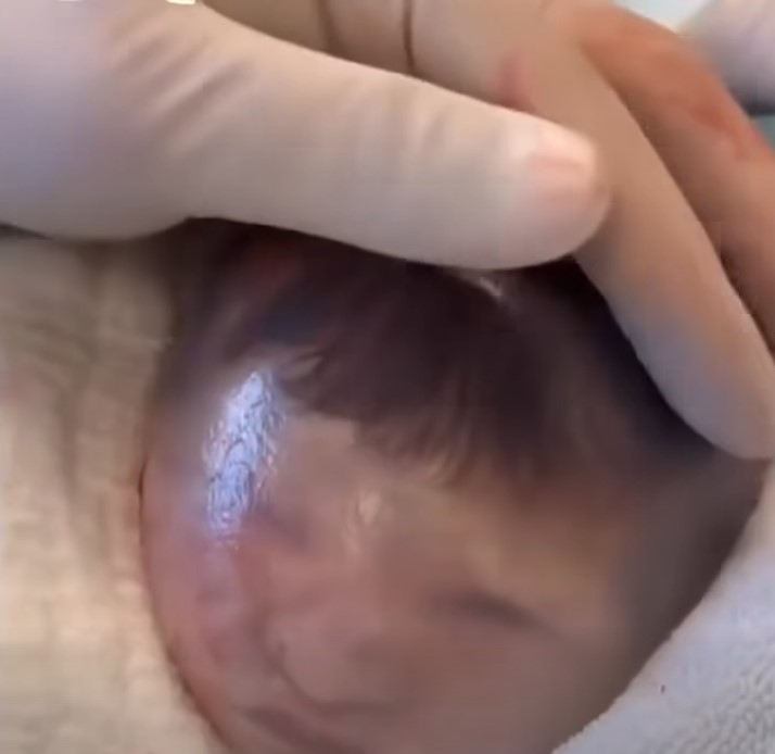 HT1. Baby born with an DIU peg… See More