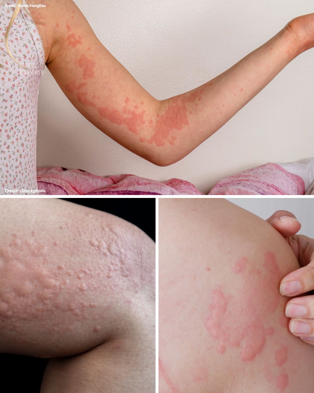 HT15. If your body itches and these bumps appear on your skin… See more