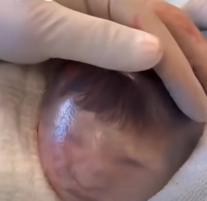 HT6. Baby born with an DIU peg… See More