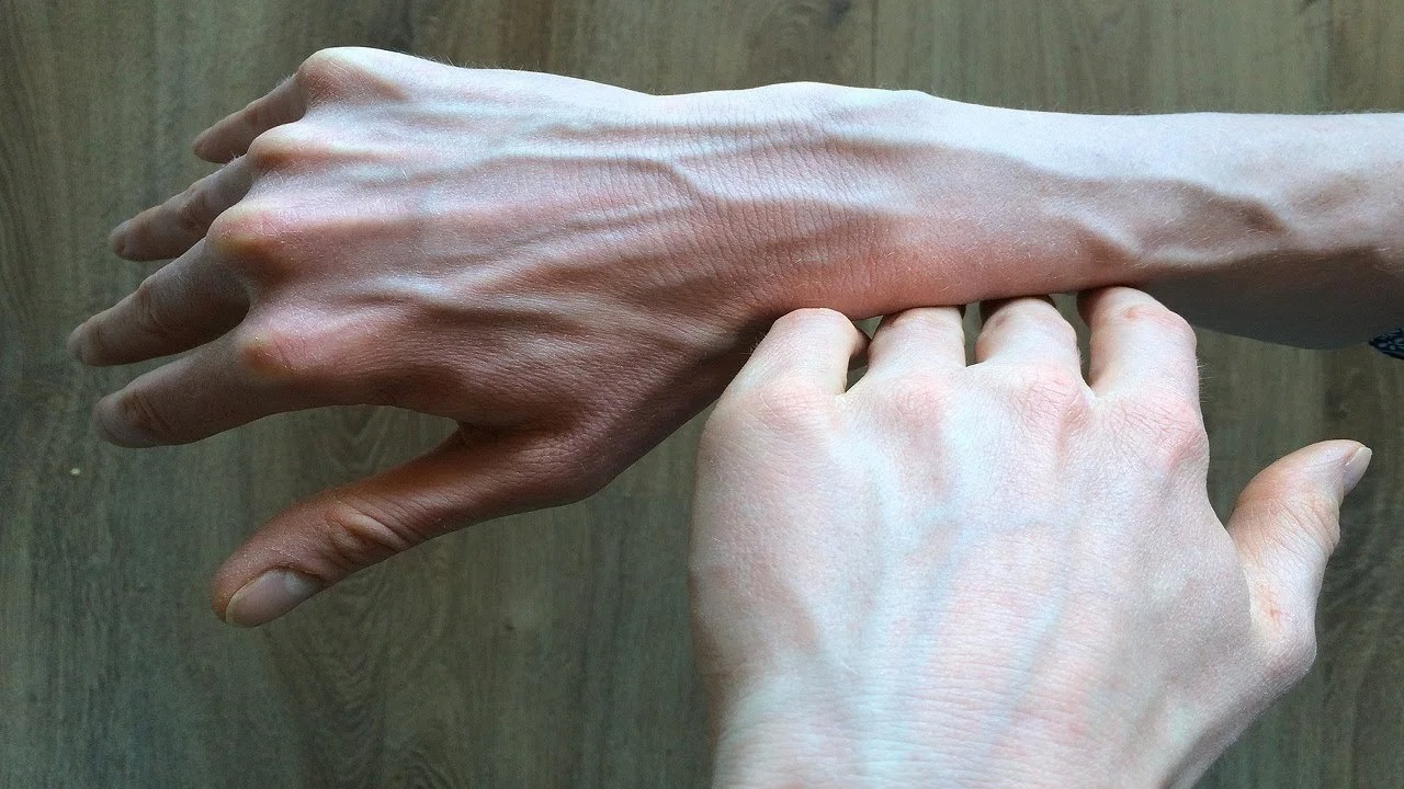 HT14. When to Worry About Veins That Appear Out of Nowhere