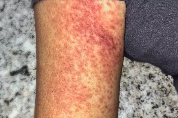 HT6. ALERT: Disease Outbreak in China — Over 7,000 Cases Reported, Symptoms and Risks Revealed