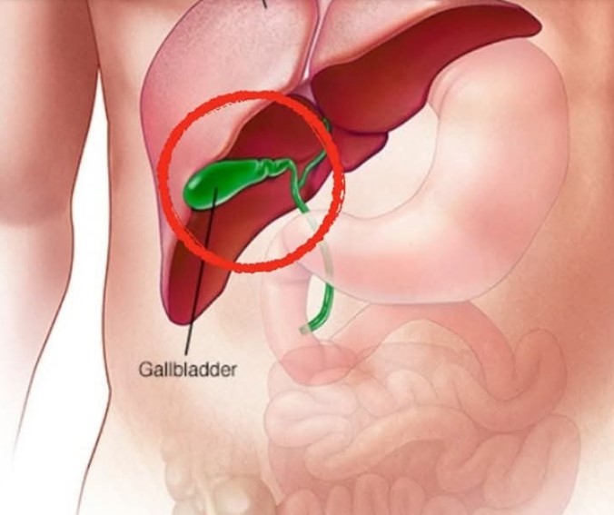 HT6. What happens to your body after gallbladder is removed