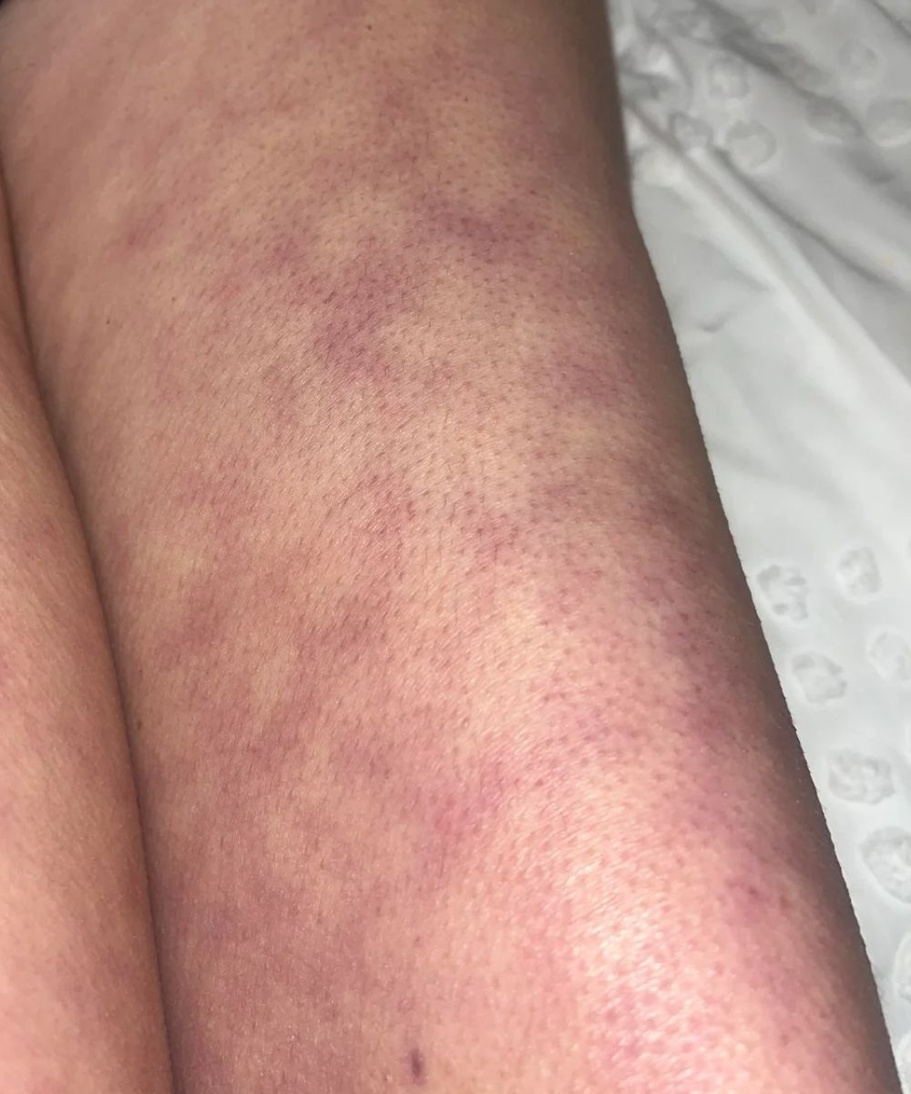 HT10. What Those Strange Skin Patterns Might Really Mean