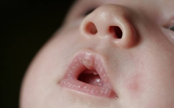 HT14. If your baby has these marks it means…