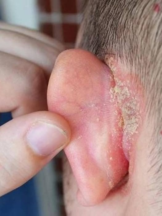 HT1. I noticed a strange patch of skin on my sons ear, and with his doctor appointment still a week away