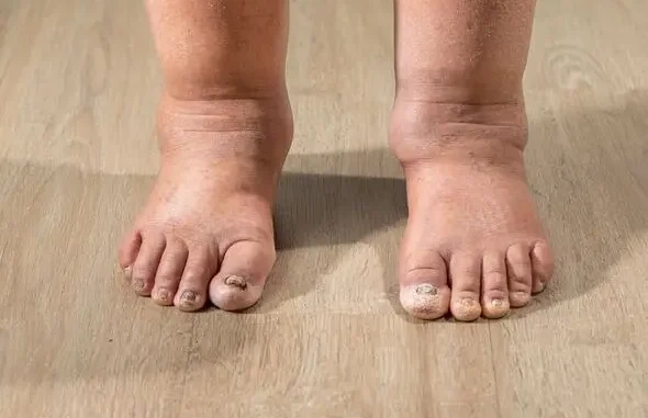 HT7. Health Warning Signs on Your Feet You Should Never Ignore