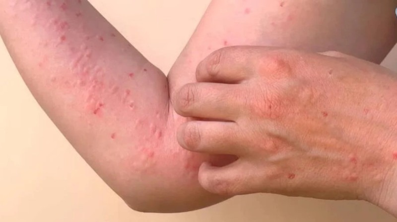 HT14. ALERT: New Disease Outbreak in China — Over 7,000 Cases Reported, Symptoms and Risks Revealed…