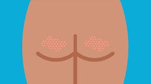 ST7. Pimples on the Buttocks: What You Need to Know