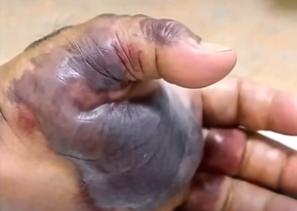 HT6. Blackened Hand Highlights the Hidden Dangers of Untreated Infections