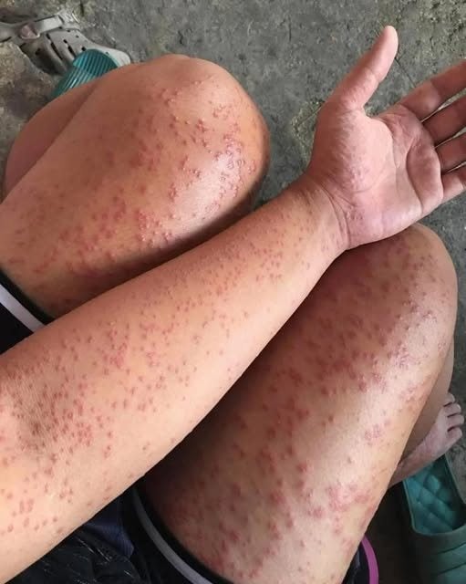 HT10. I Slept at my friends old apartment for a couple days noticed these weird bump…See more