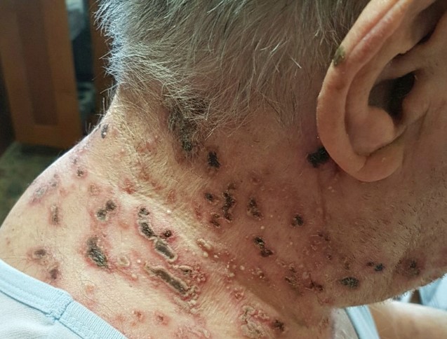 HT14. This is the silent disease that is triggered when you come into contact with … See more