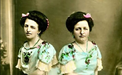 HT7. The Incredible Story of the Siamese Twins: One Fell in Love, Had a Baby — and Both Became Mothers…