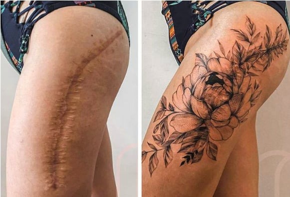 ST14. Tattoos can help you turn scars into something beautiful