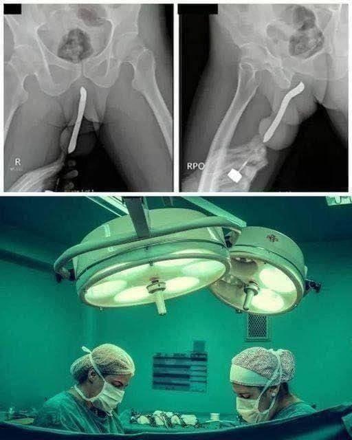 HT1. Girl had to be hospitalized for wanting to use a pe…See more