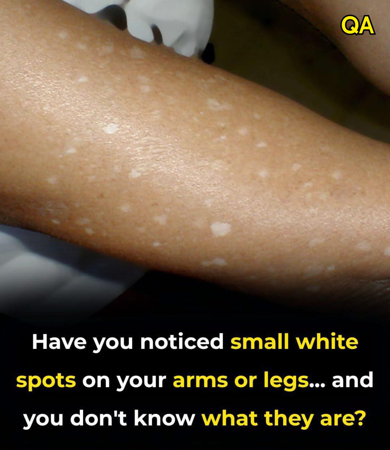 HT6. Have you noticed small white spots on your arms or legs… and you don’t know what they are?