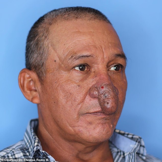 ST7. Painter, 57, with a deformed nose is given a new one for Christmas