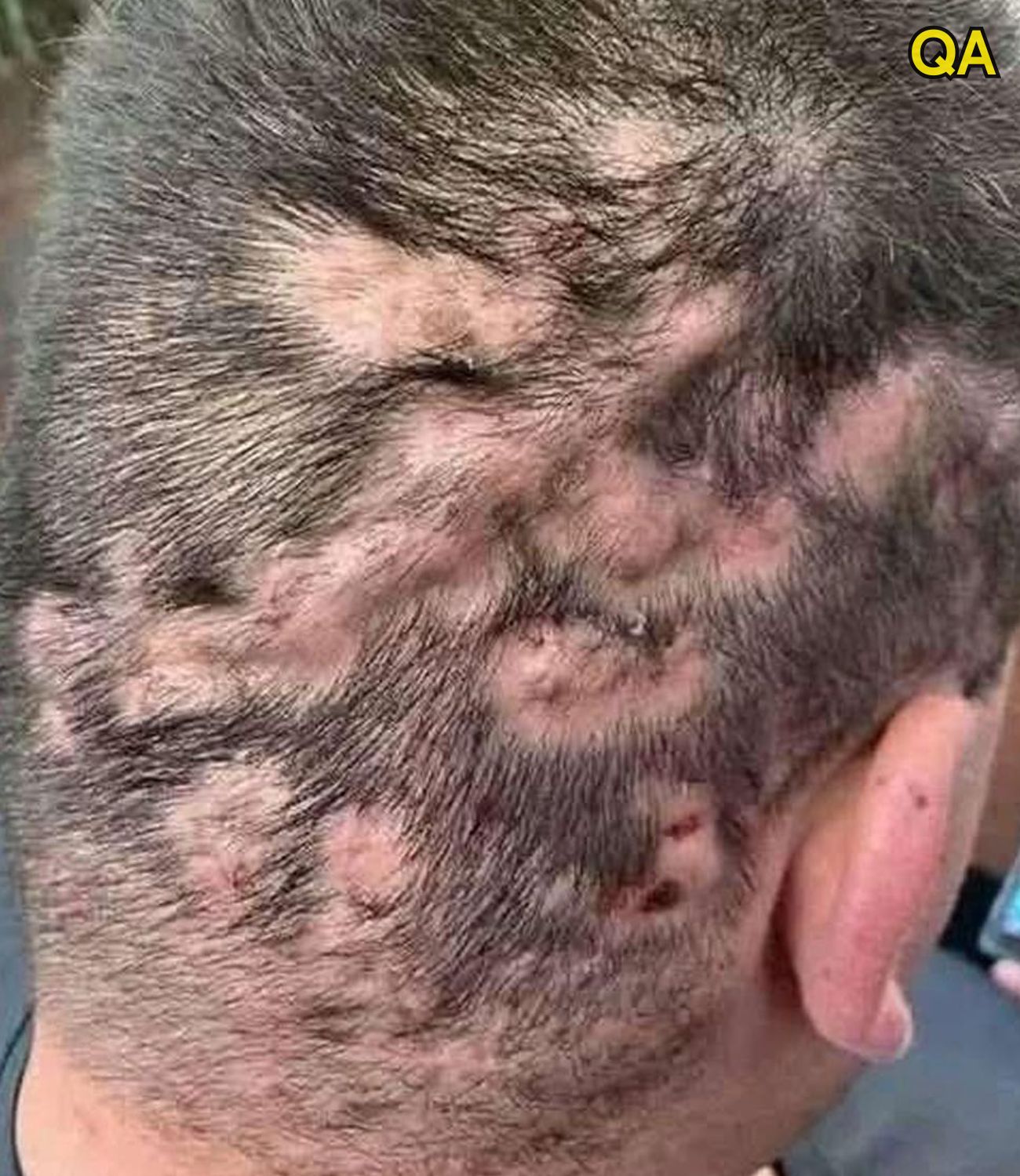 HT1. These are the first symptoms