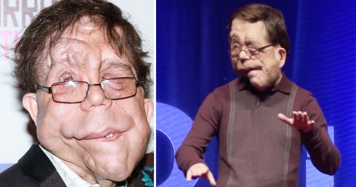 ST1. The incredible story of actor Adam Pearson: He’s an inspiration to millions
