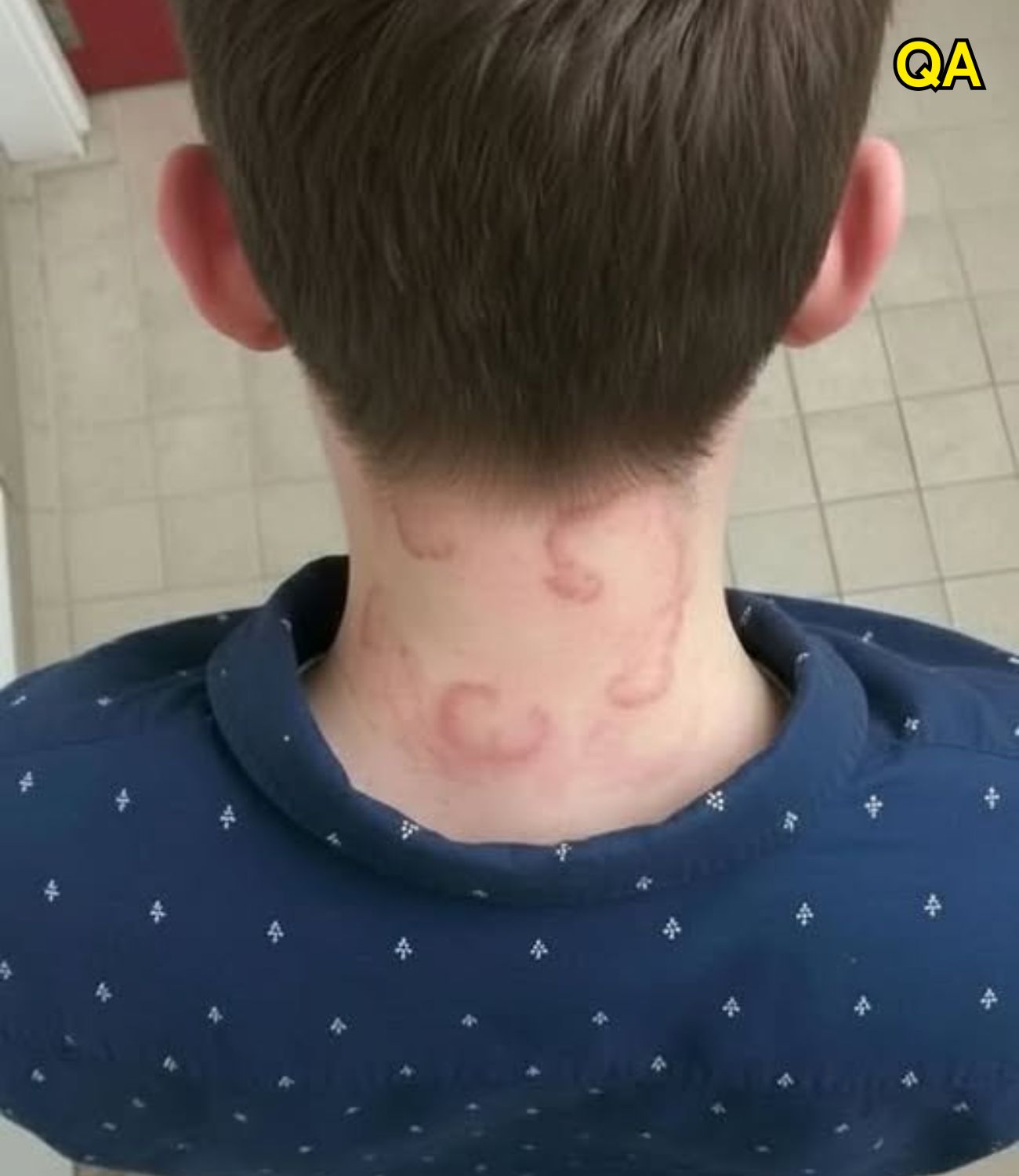 HT1. My 8 year old son been having this for 2 months straight it’s gotten worse from the first time he had this.. What is it