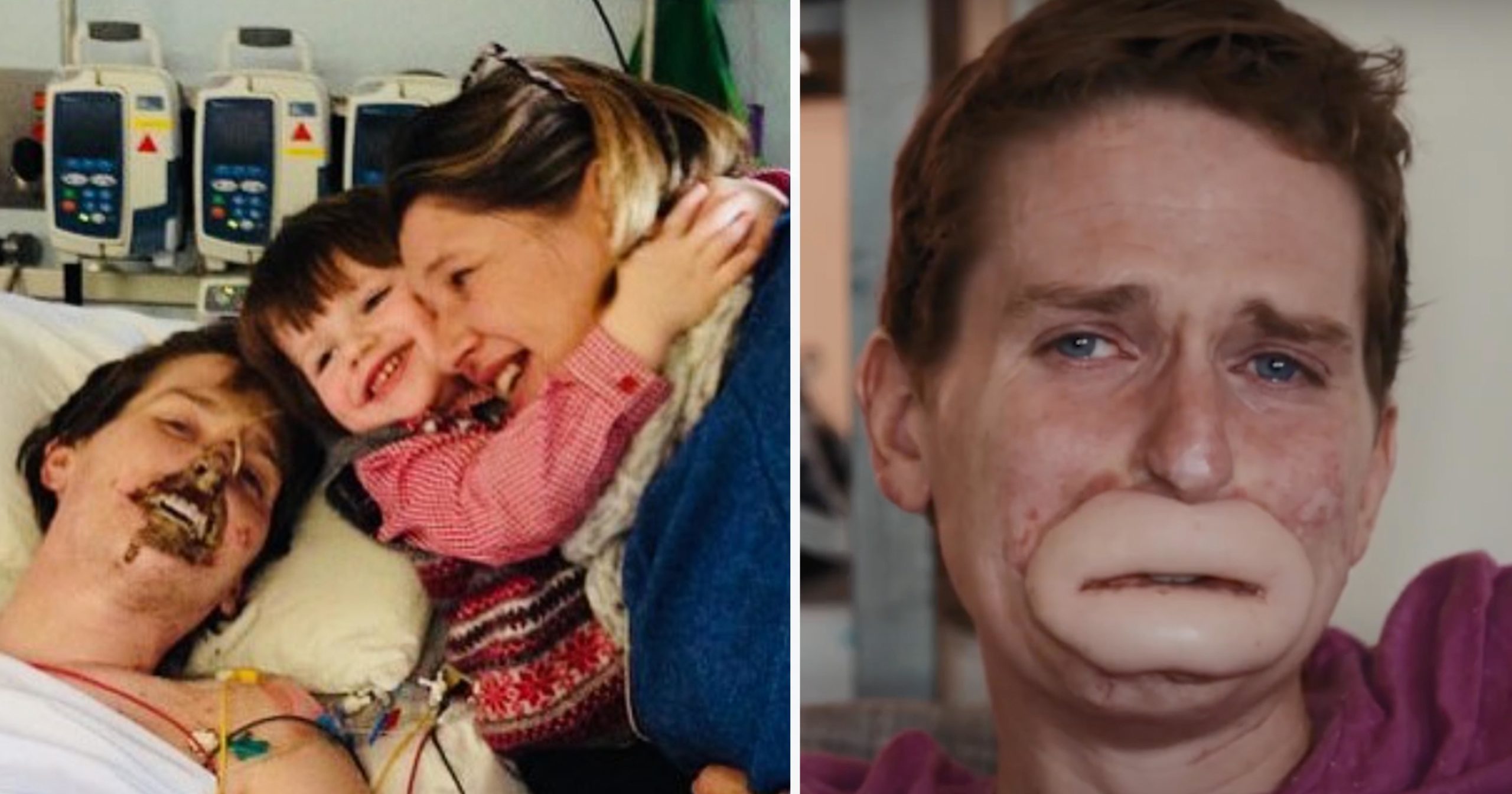 ST10. Dad left unrecognizable after losing his lips and four limbs to flesh-eating bug