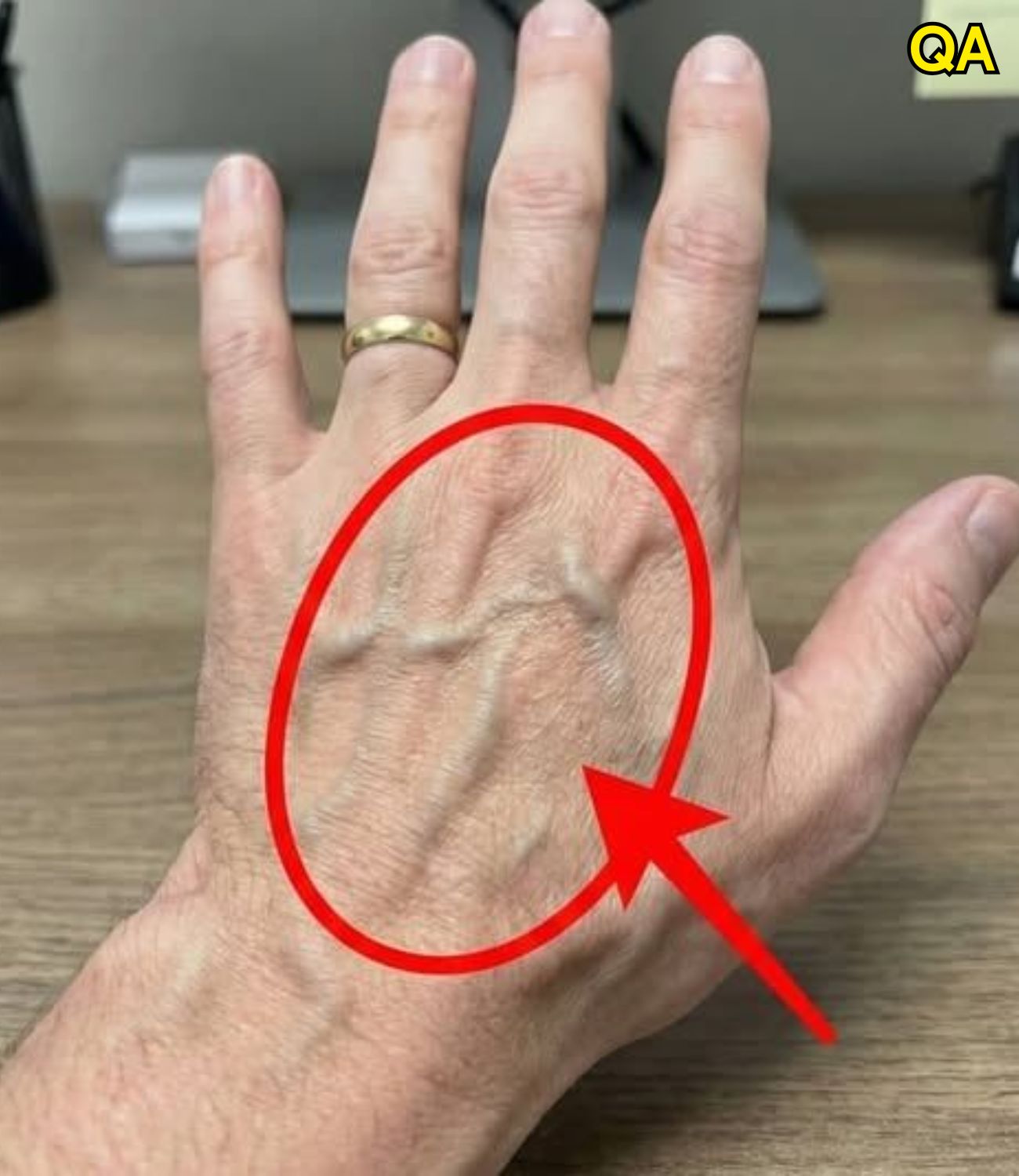 HT14. If you have visible veins, it means you are… See more