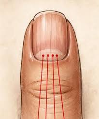 HT14. If you have these lines on your nails after 40, it is a clear sign that..