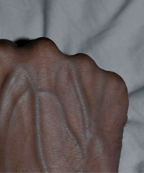 HT1. If you have visible veins, it means you are….