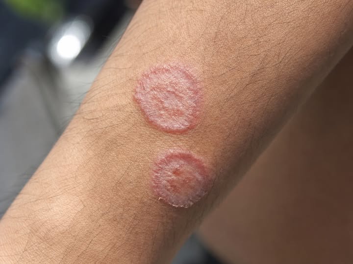 HT1. HIDDEN DANGERS LURKING ON YOUR SKIN THAT COULD KILL YOU IN MINUTES