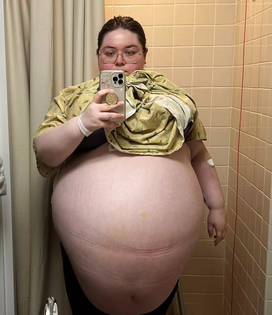 ST7. ‘It felt like my organs were being crushed,’ said a 20-year-old woman from Florida after having a 100-pound ovarian cyst