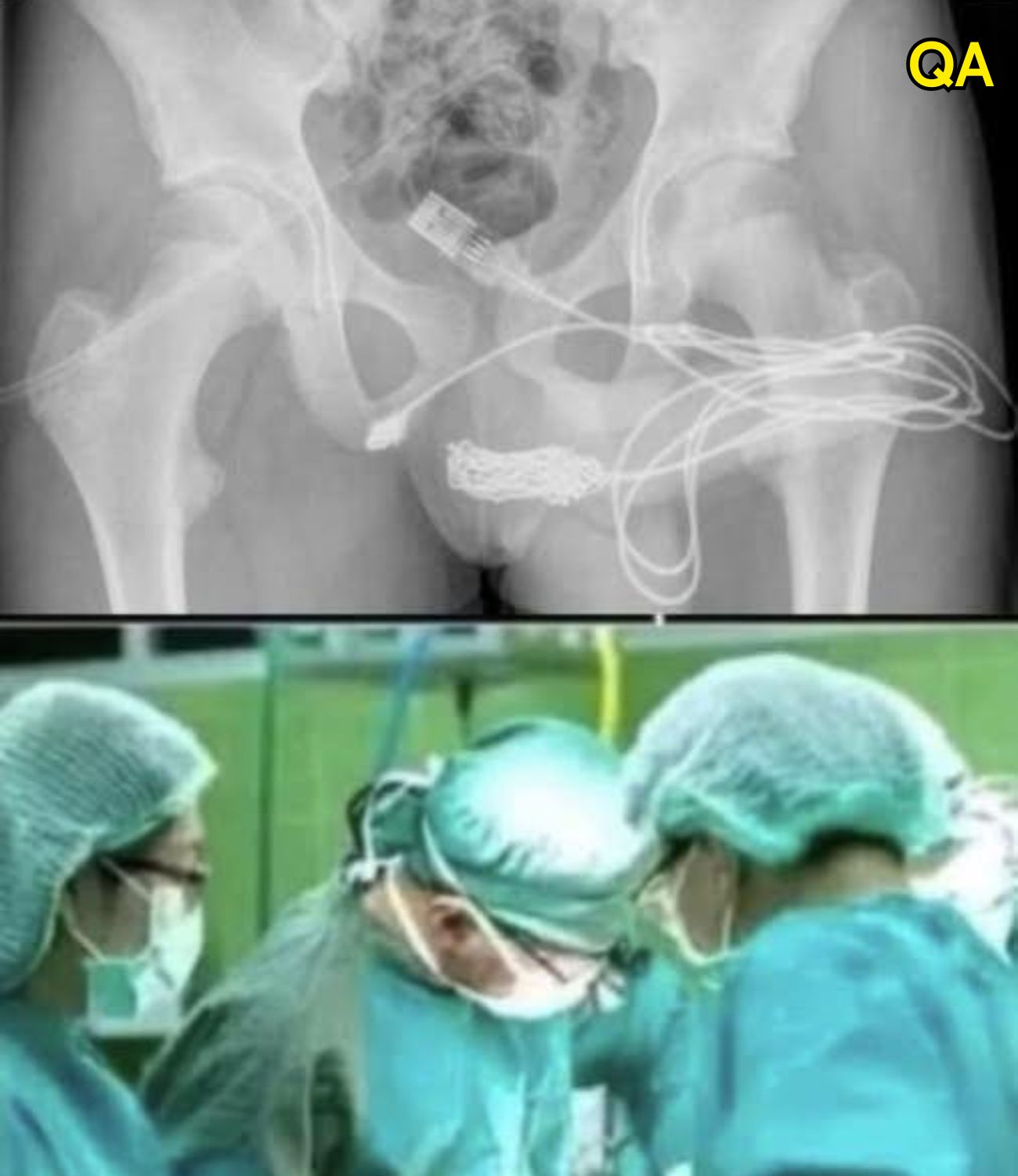HT7. Girl had to be hospitalized for wanting to use a pe…See more