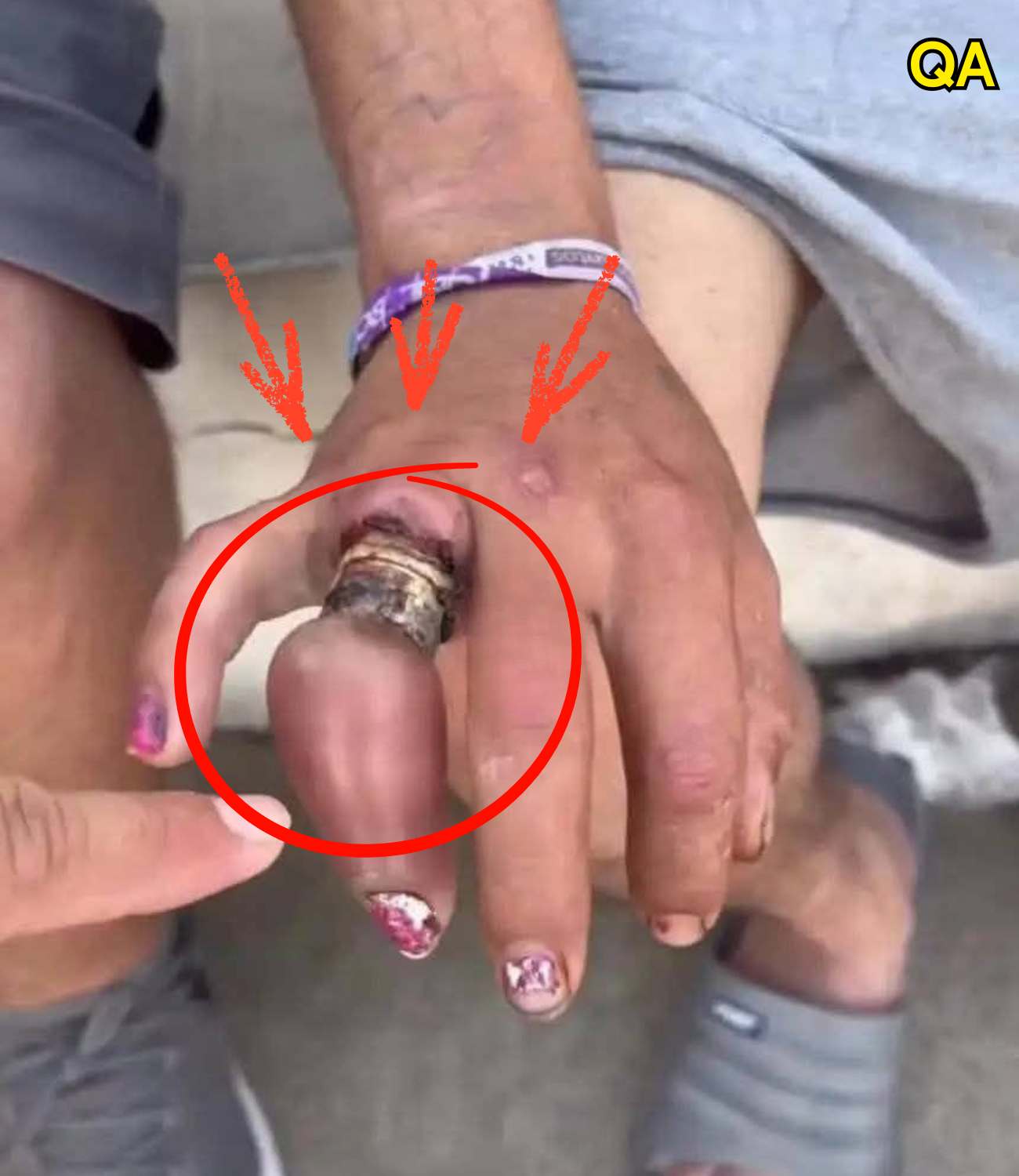 HT1. He promised never to take off his wedding ring… and ended up losi…See more