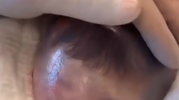 HT14. Baby born with an DIU peg… See more