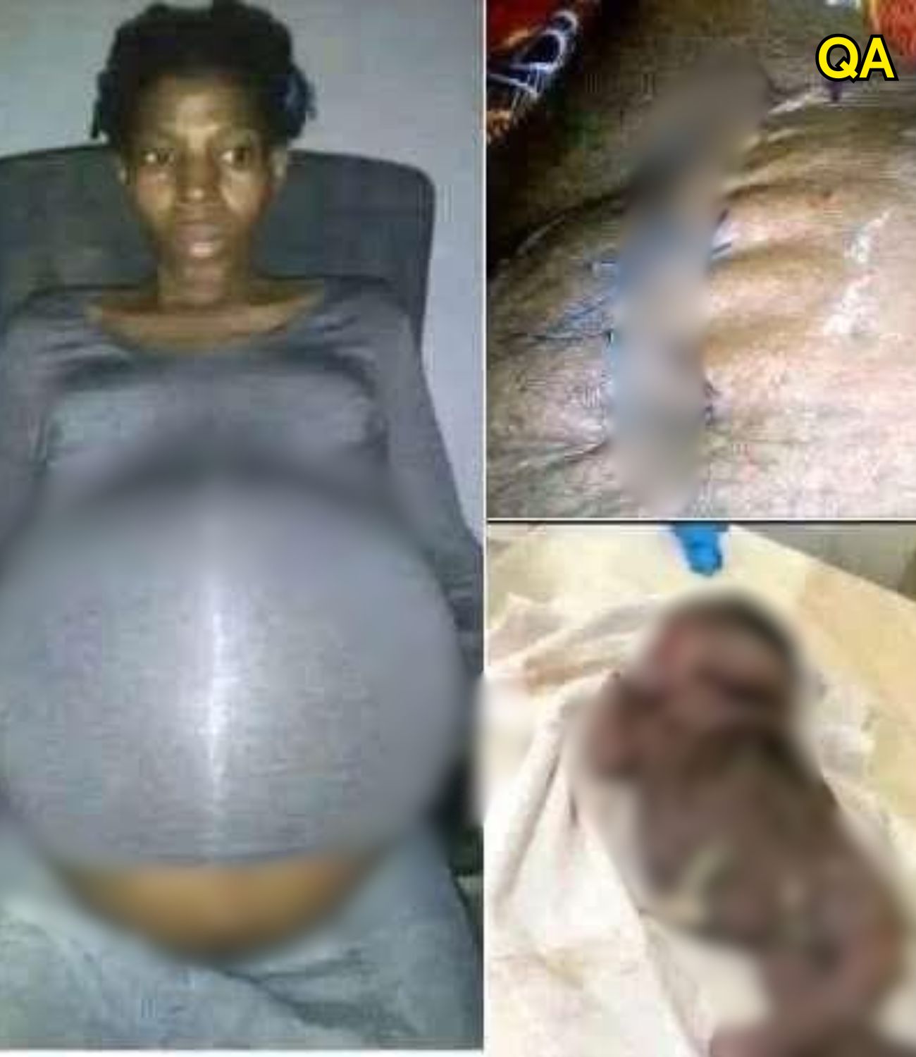 HT14. A 30-year-old woman in Georgia was declared brain dead