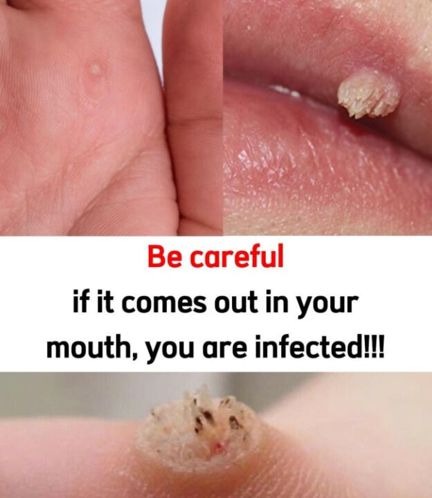 HT1. These are the first signs of an enf…See more…
