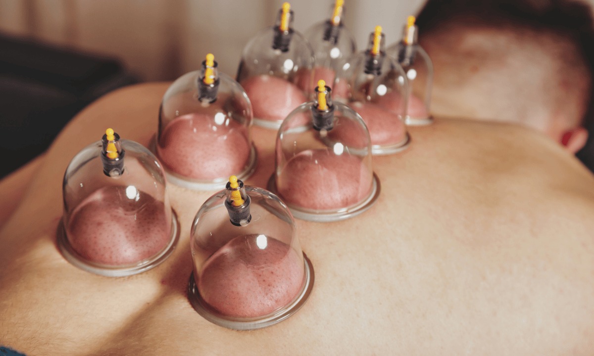 ST6. What Is Cupping Therapy? Benefits, Types, and Safety Tips
