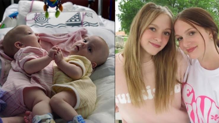 ST1. Conjoined Twins Who Were Separated Through Surgery Almost 18 Years Ago Are Living Life Like Normal Teenagers Today